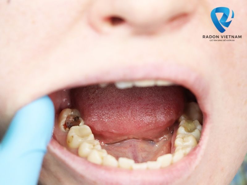 mẹo chữa đau răng cho trẻ em