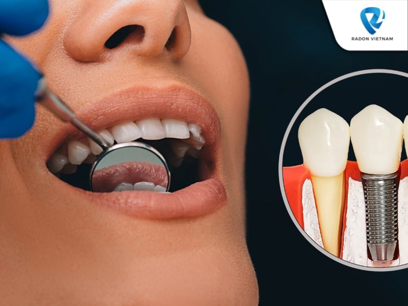 trồng răng implant