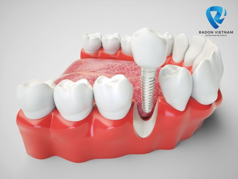 trồng răng implant