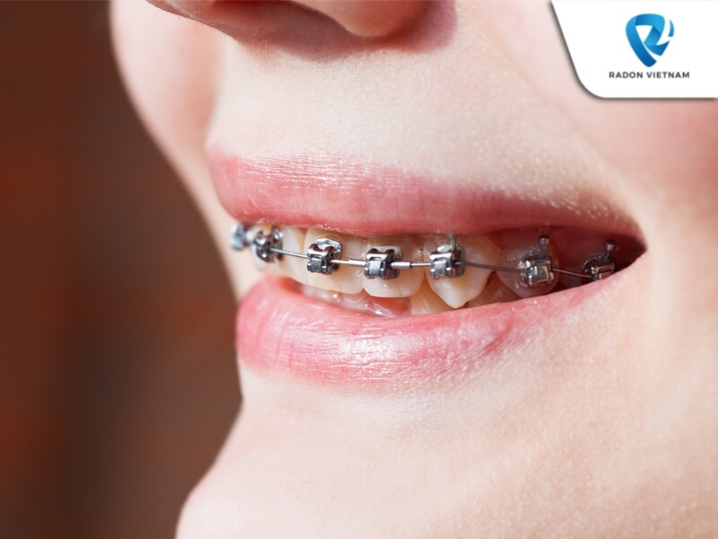 Niềng răng khớp cắn ngược