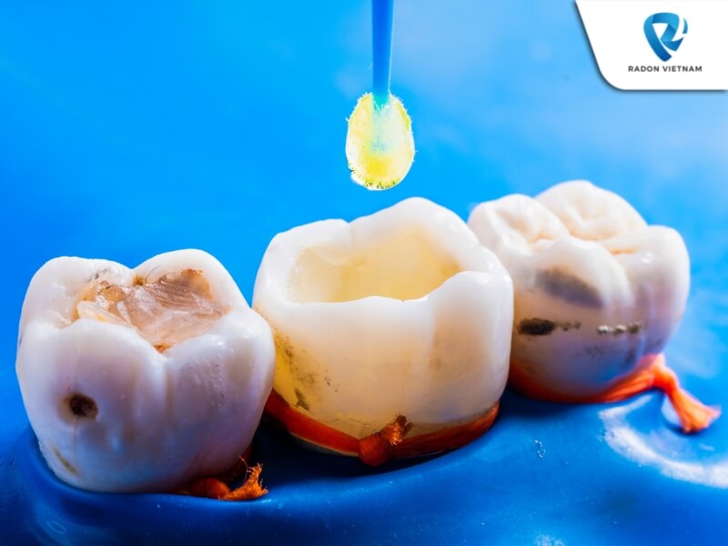 Nha sĩ không khuyến khích lấy tủy vì điều này có thể khiến răng bị yếu đi và dễ gãy (Nguồn ảnh: Sưu tầm)