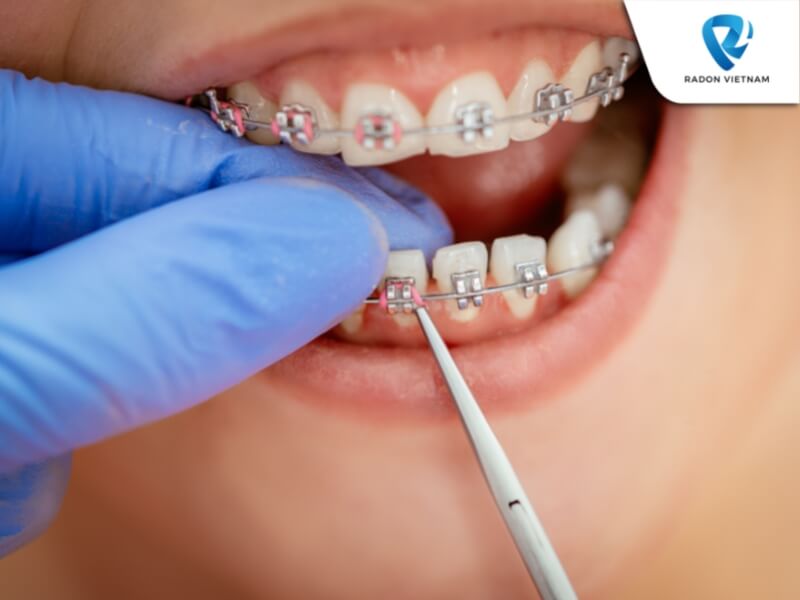 Làm sao để niềng răng không bị hóp má