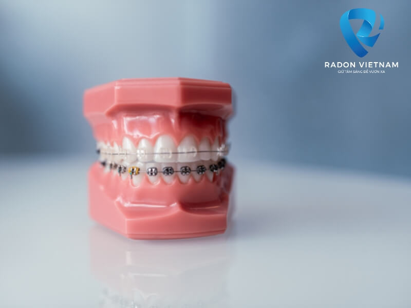 Làm sao để niềng răng không bị hóp má