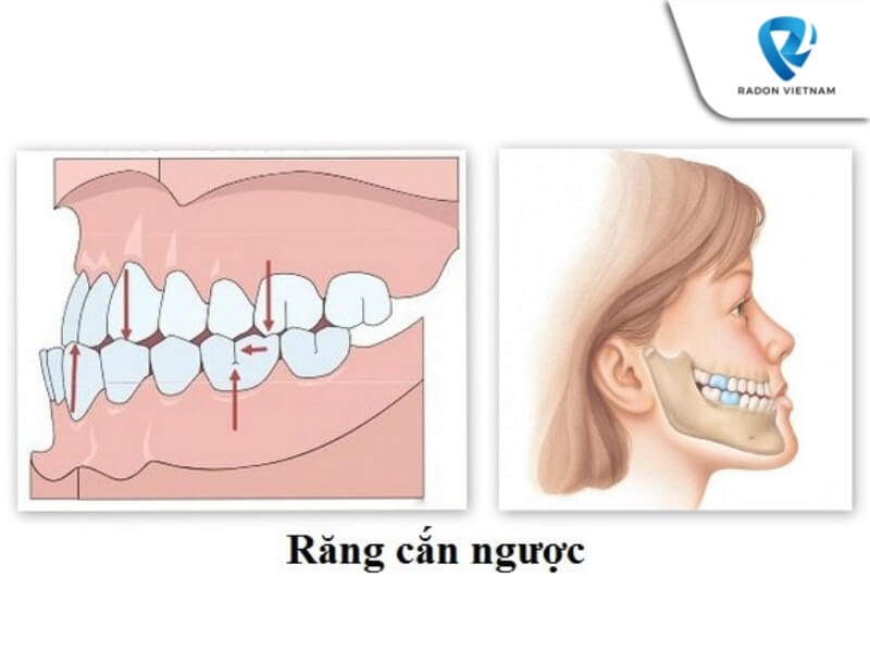 Niềng răng khớp cắn ngược