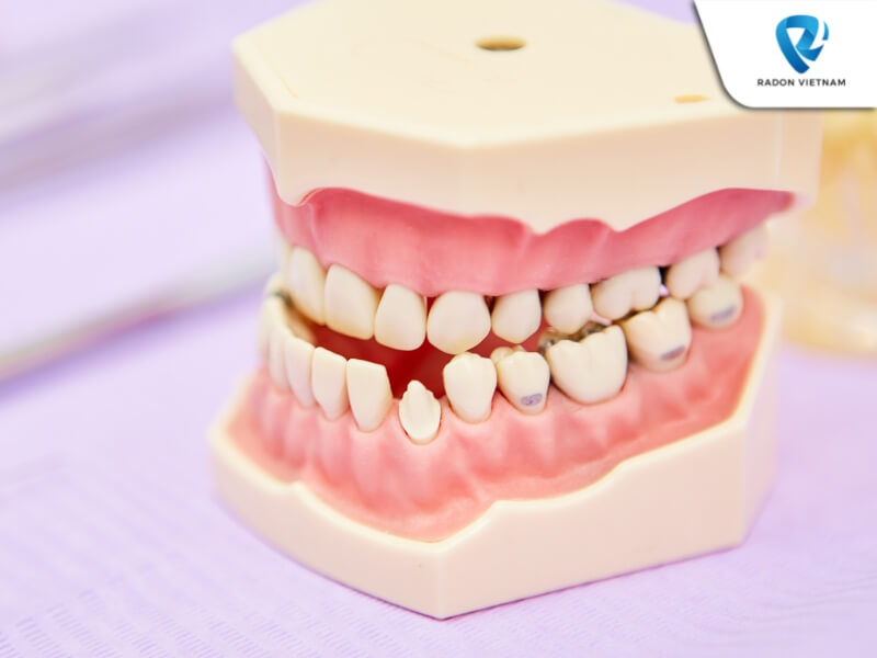 mất răng số 6 có niềng được không