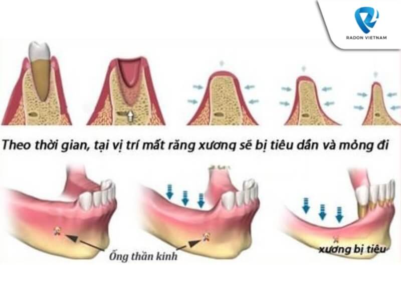 mất răng số 6 có niềng được không