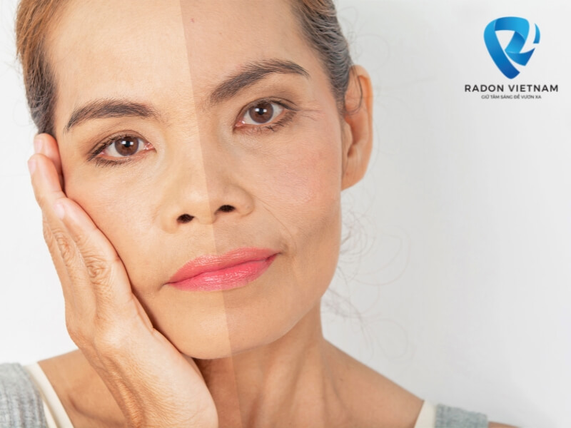 Làm sao để niềng răng không bị hóp má