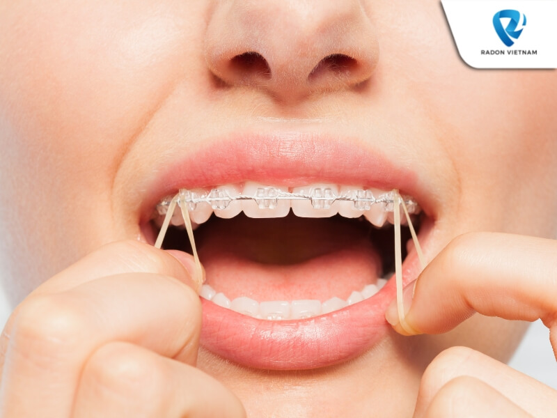 Giải pháp này sẽ giúp hàm răng của bạn được cải thiện đáng kể và đảm bảo khả năng ăn nhai (Nguồn ảnh: Sưu tầm)