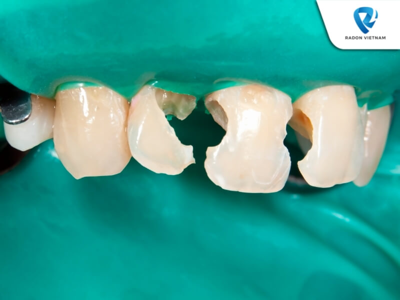 Bọc răng sứ có cần lấy tủy không