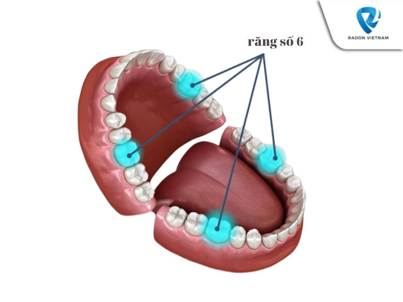mất răng số 6 có niềng được không
