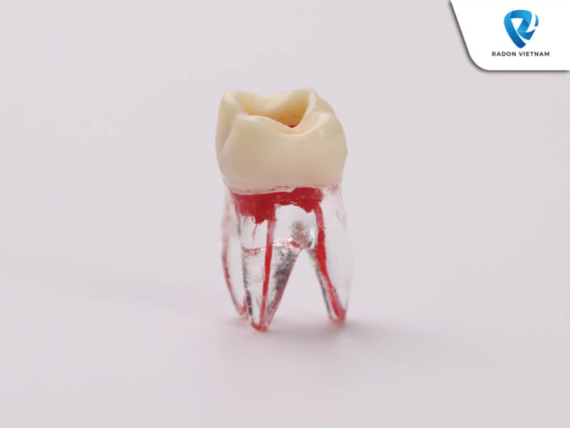 bọc răng sứ có cần lấy tủy không