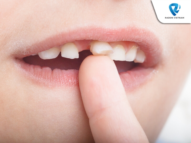 Viêm tủy răng sữa ở trẻ cần được điều trị kịp thời nhằm hạn chế các biến chứng khôn lường (Nguồn ảnh: Sưu tầm)