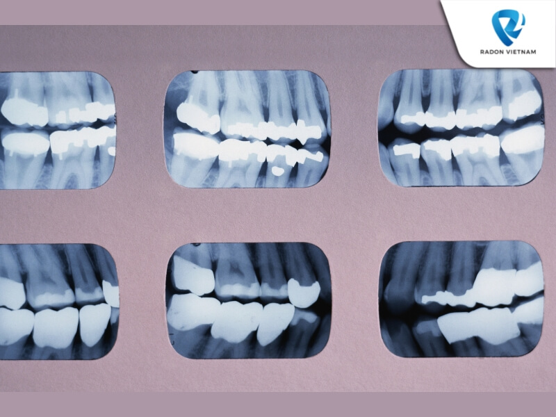 Các trường hợp được chỉ định chụp XQ bao gồm niềng răng, viêm nha chu và cấy ghép Implant (Nguồn ảnh: Sưu tầm)