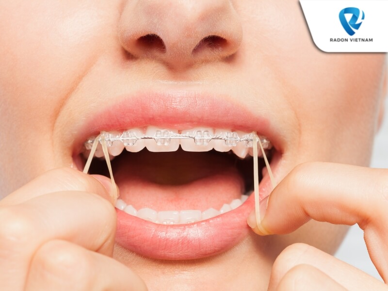 Kiểm soát lực có thể coi là một trong những thách thức lớn nhất của ngành chỉnh nha (Nguồn ảnh: Sưu tầm)