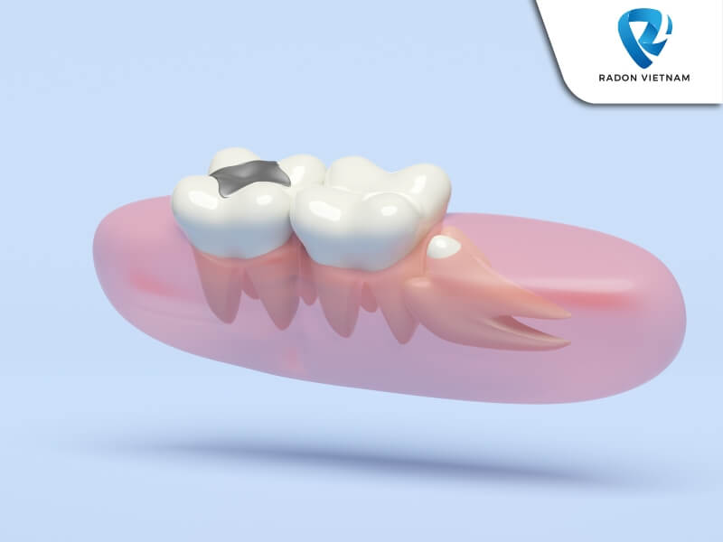 Các trường hợp thường gặp: mọc thẳng đứng; lệch 90 độ; lệch gần (Nguồn ảnh: Sưu tầm)