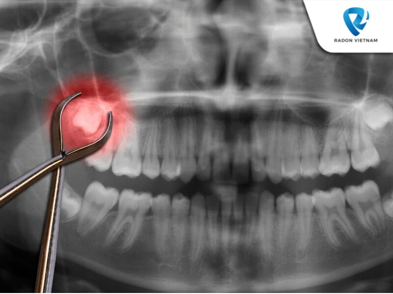 Nha sĩ sẽ thấy được mối liên kết giữa chân răng và hệ thống dây thần kinh (Nguồn ảnh: Sưu tầm)