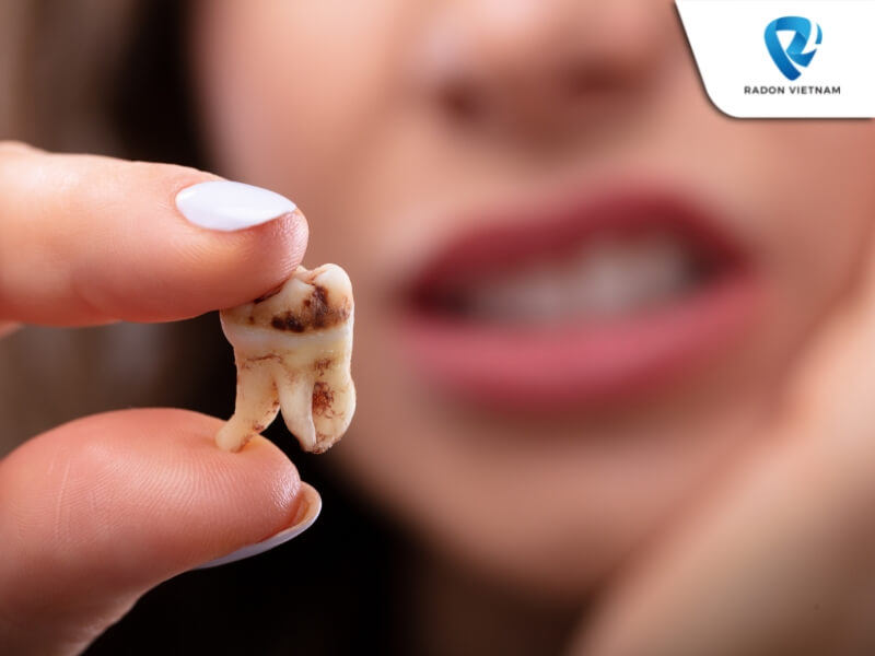 Sâu răng kéo dài ở răng khôn có thể ảnh hưởng trực tiếp tới các răng bên cạnh (Nguồn ảnh: Sưu tầm)