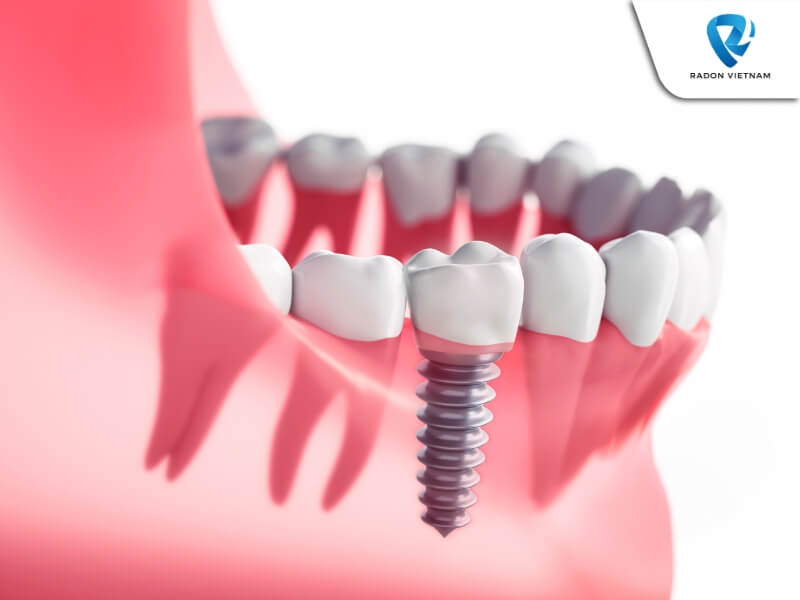 Trước khi phẫu thuật cấy ghép implant, bạn cần chụp X-Quang, chia sẻ tình trạng bệnh lý cá nhân và kế hoạch điều trị (Nguồn ảnh: Sưu tầm)