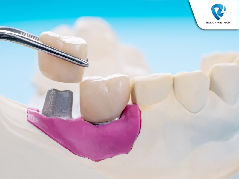 Bạn có thể thực hiện phẫu thuật khi bạn mất một hoặc nhiều răng, xương hàm phát triển đầy đủ,.. (Nguồn ảnh: Sưu tầm)