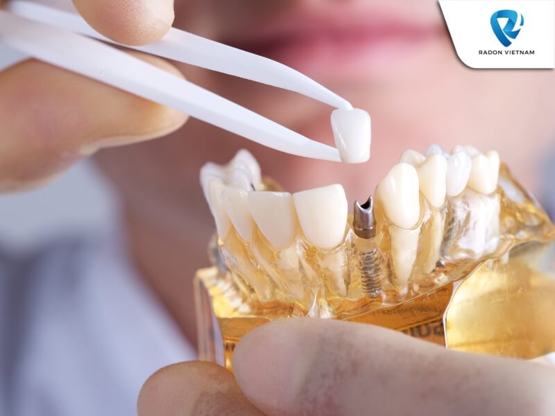 Trụ implant đóng vai trò chân răng nên nó cần được cấy sâu vào trong xương (Nguồn ảnh: Sưu tầm)