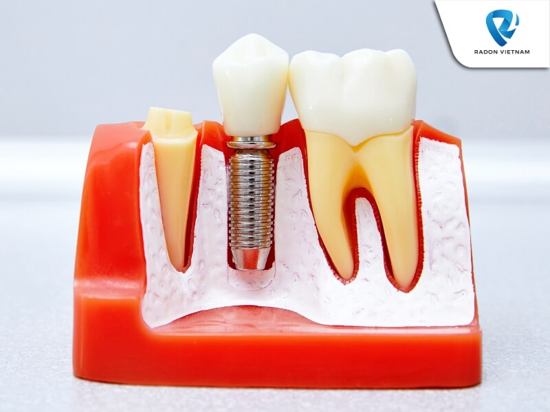 Nhiễm trùng tại vị trí cấy ghép là một trong những rủi ro khi phẫu thuật cấy ghép nha khoa (Nguồn ảnh: Sưu tầm)