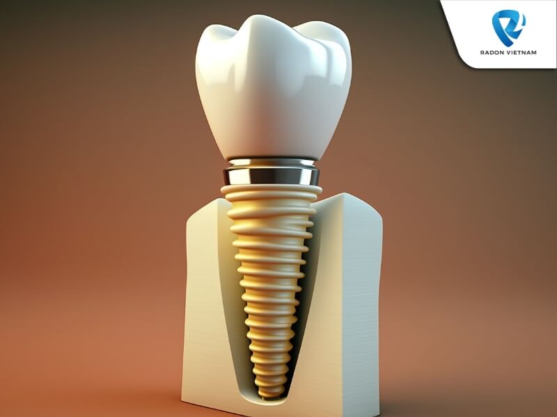 Phẫu thuật cấy ghép implant nha khoa là một phương pháp thay thế chân răng bằng các trụ kim loại (Nguồn ảnh: Sưu tầm)