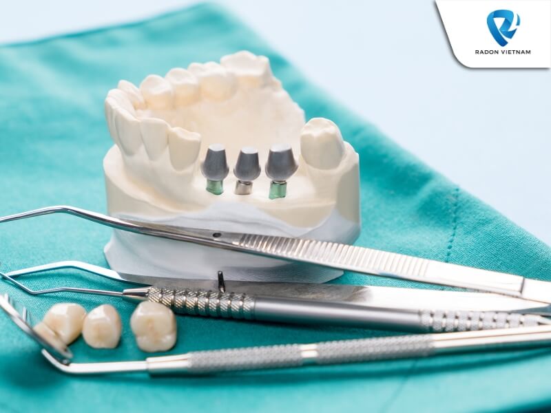 Abutment được gắn vào implant nha khoa (Nguồn ảnh: Sưu tầm)