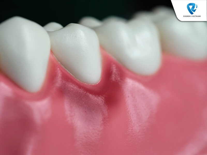 Nướu sưng và dễ chảy máu khi chăm sóc răng miệng hoặc ăn uống (Nguồn ảnh: Sưu tầm)
