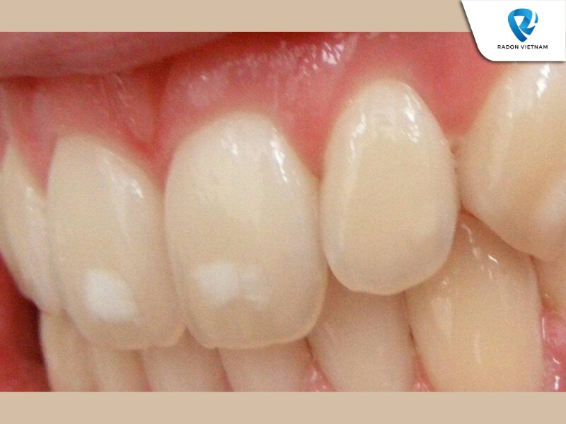 Các đốm nhỏ trắng đục xuất hiện trên bề mặt răng (Nguồn ảnh: Sưu tầm)