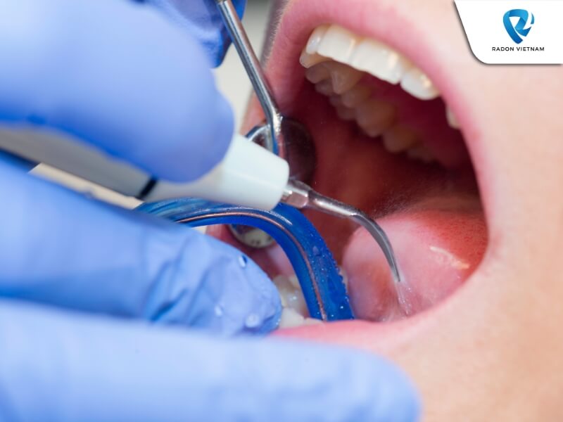Việc loại bỏ mảng bám, vôi răng còn giúp bạn bảo vệ răng khỏi sự xâm nhập của vi khuẩn (Nguồn ảnh: Sưu tầm)