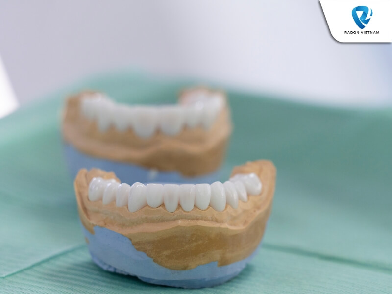 Bạn có thể áp dụng các phương pháp thẩm mỹ nha khoa để cải thiện tình trạng nhiễm fluor (Nguồn ảnh: Sưu tầm)