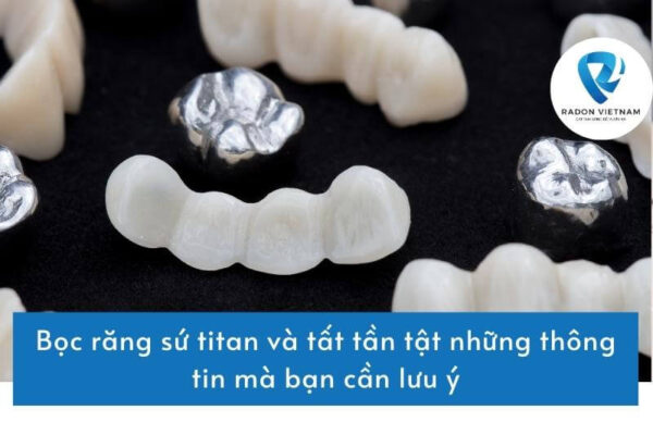 Bọc răng sứ titan và tất tần tật những thông tin mà bạn cần lưu ý