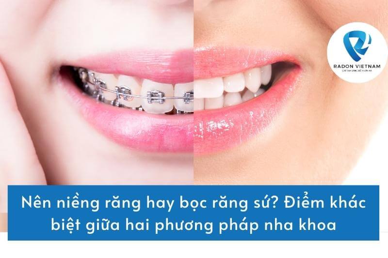 Nên niềng răng hay bọc răng sứ? Điểm khác biệt giữa hai phương pháp nha khoa