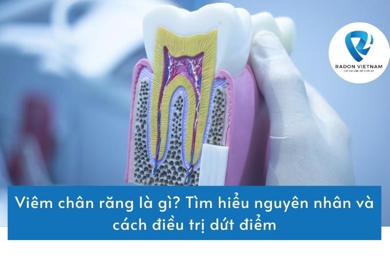 Viêm chân răng là gì? Tìm hiểu nguyên nhân và cách điều trị dứt điểm