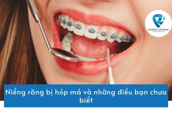 Niềng răng bị hóp má và những điều bạn chưa biết