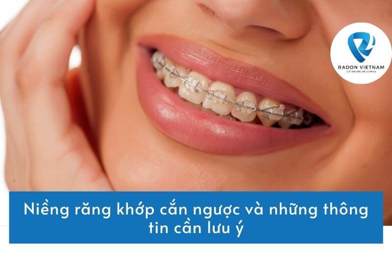 Niềng răng khớp cắn ngược và những thông tin cần lưu ý