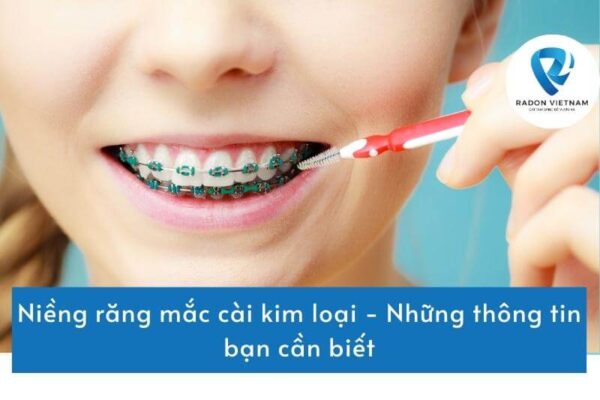 Niềng răng mắc cài kim loại - Những thông tin bạn cần biết