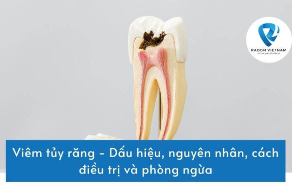 Viêm tủy răng - Dấu hiệu, nguyên nhân, cách điều trị và phòng ngừa