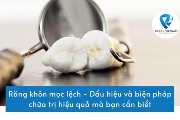 Răng khôn mọc lệch - Dấu hiệu và biện pháp chữa trị hiệu quả mà bạn cần biết