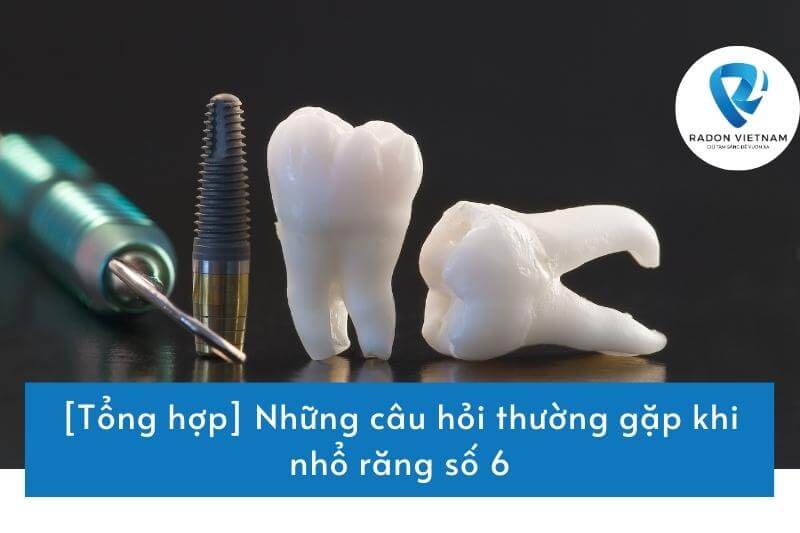 [Tổng hợp] Những câu hỏi thường gặp khi nhổ răng số 6
