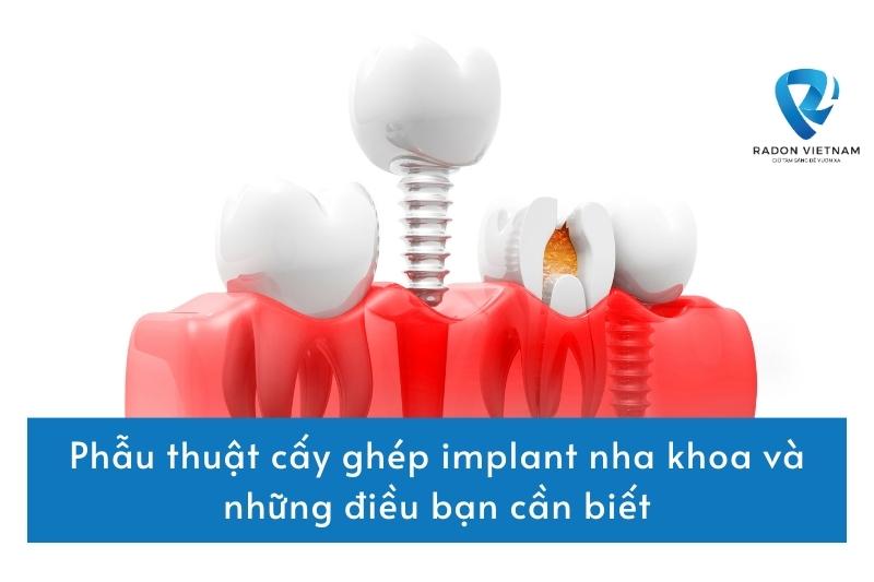 Phẫu thuật cấy ghép implant nha khoa và những điều bạn cần biết
