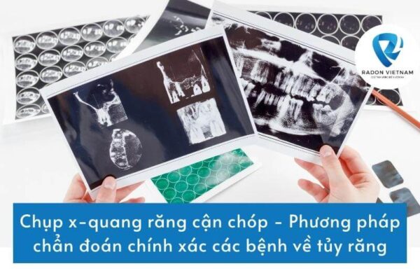 Chụp x-quang răng cận chóp - Phương pháp chẩn đoán chính xác các bệnh về tủy răng