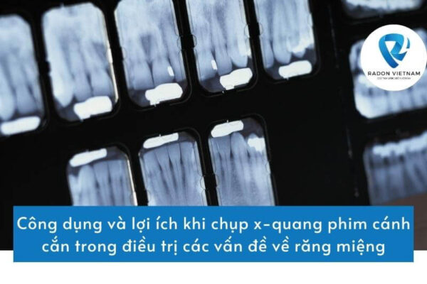 Công dụng và lợi ích khi chụp x-quang phim cánh cắn trong điều trị các vấn đề về răng miệng